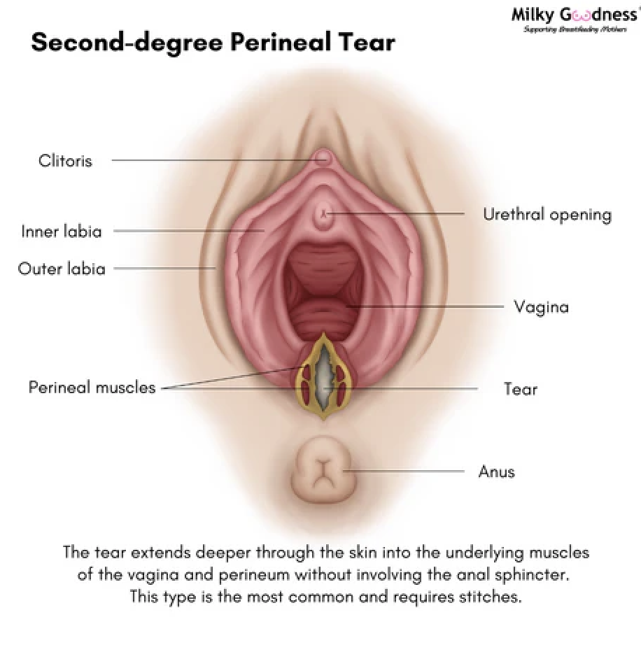 Diagram of vagina after a second degree perineal tear